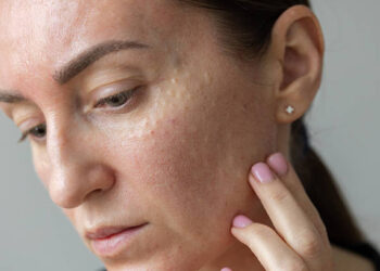Transform Your Skin with Microneedling Charleston, SC – Well Labs+ MedSpa Charleston